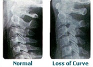 Chiropractic Treatment X-rays Canada