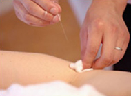 Acupuncture Treatment