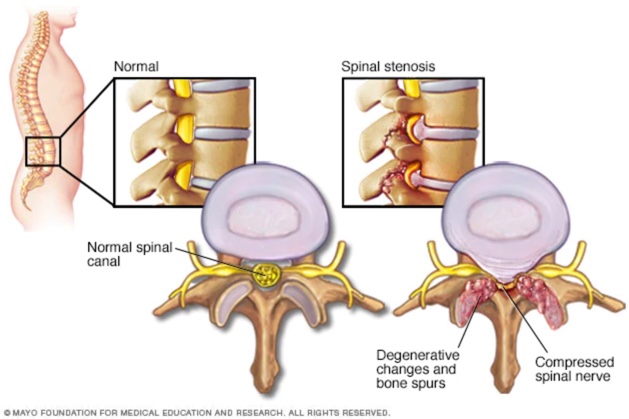 spinal-stenosis-chiropractor